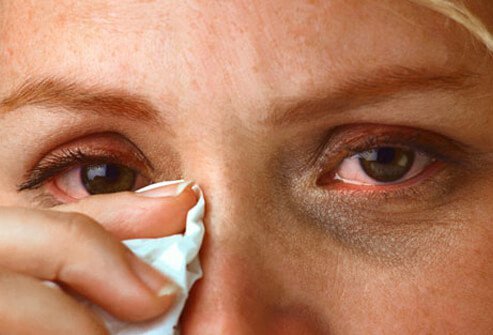 Dark circles are another sign of allergies.