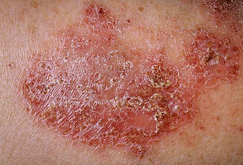Photo of nummular eczema.