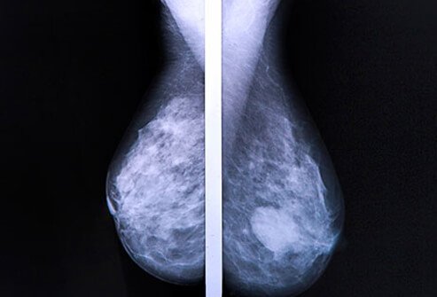 A side-by-side view of mammograms, one with a cancerous tumor and one without.