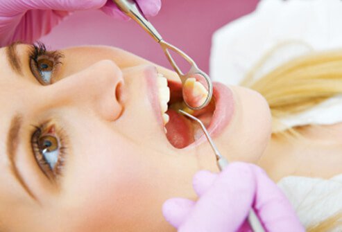 White patches inside the mouth or white spots on the tongue may be signs of a precancerous condition called leukoplakia that can lead to oral cancer.