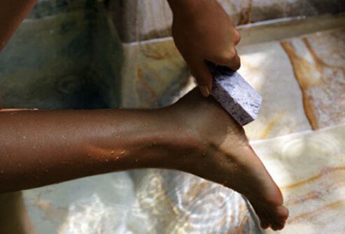 Most people have calluses on the heels and balls of their feet.