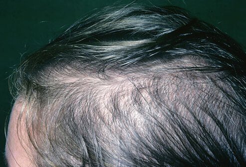 Hair loss in women is more common than you might think.