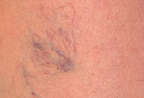 Women with jobs that keep them on their feet are more likely to develop spider veins.