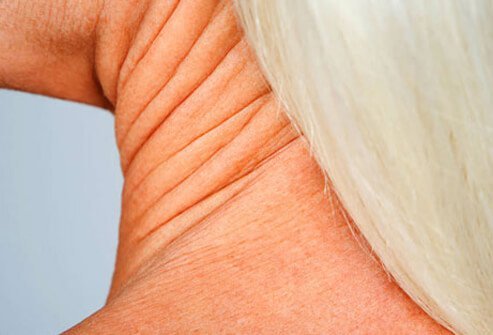 If you've lost a lot of weight, you may have extra skin hanging around the neck.