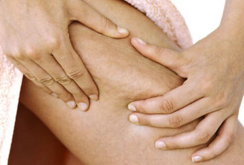A pinch will show lumpy skin on just about every woman.