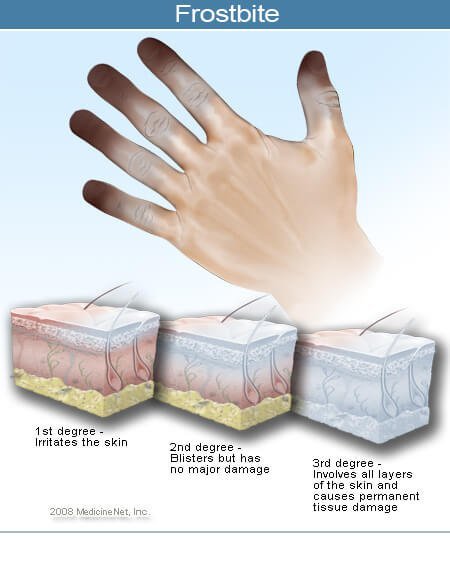 Picture of the Stages of Frostbite