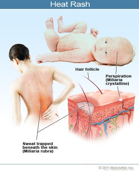 Pictures of heat rash in children and adults