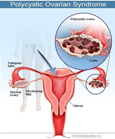 Picture of Polycystic Ovarian Syndrome (PCOS)