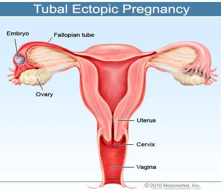 Picture of an ectopic or tubal pregnancy