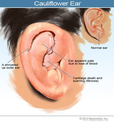 Picture of a normal ear and a cauliflower ear