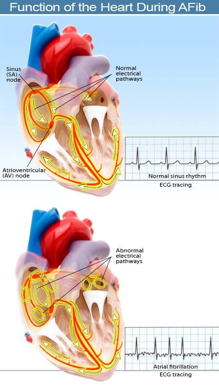 Picture of the Electrical Activity of the Heart During Atrial Fibrillation