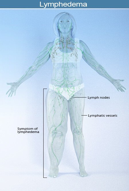 Picture of Lymphedema