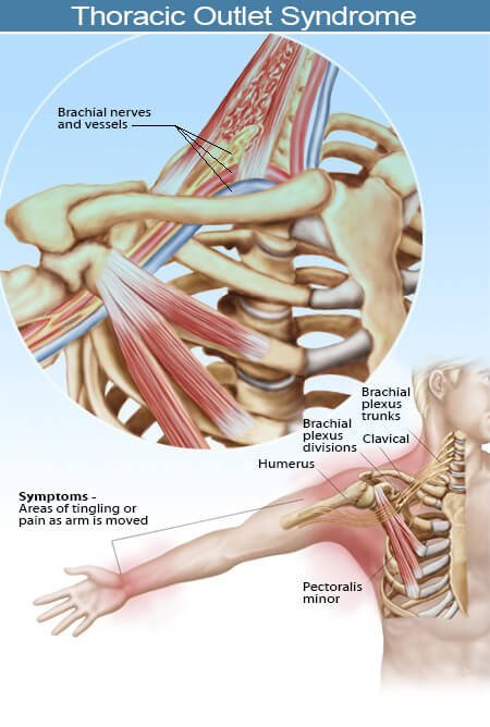Picture of thoracic outlet syndrome (TOS) showing symptom areas