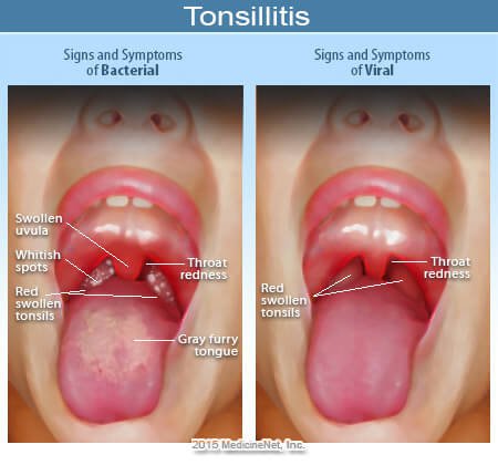 Picture of bacterial and viral tonsillitis