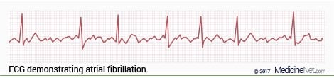 ECG wave pattern of atrial fibrillation