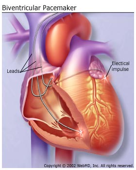 Biventricular Pacemaker Heart Illustration