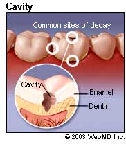Picture of cavities