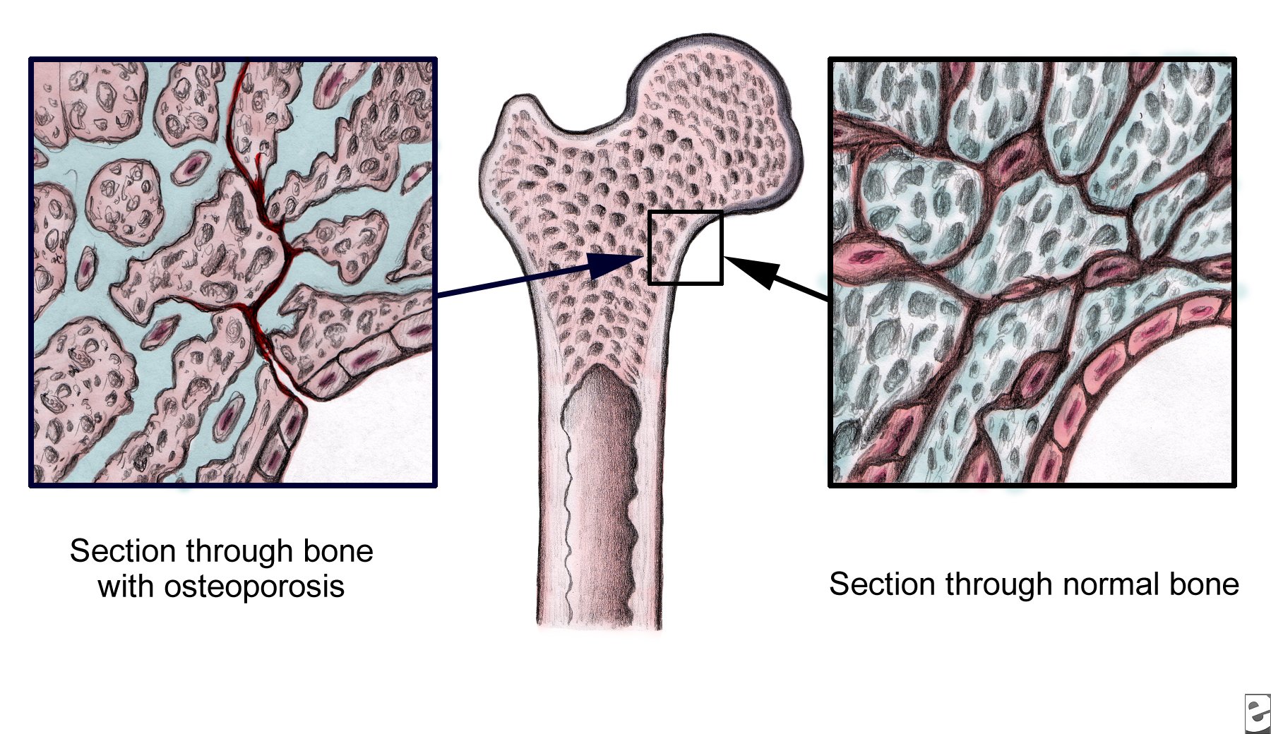 Osteoporosis