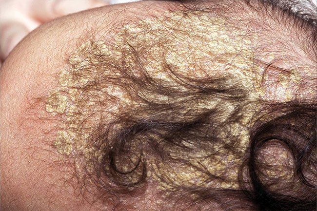 Cradle cap, or seborrheic eczema, is a condition that often clears up without treatment.