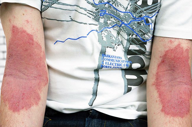 Eczema in adults appears on bending areas of the body like the inside of elbows and back of the knees.