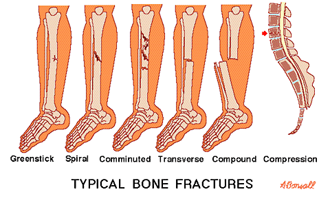 Typical Bone Fractures illustration - Torsion fracture Typical Bone Fractures illustration - Torsion fracture