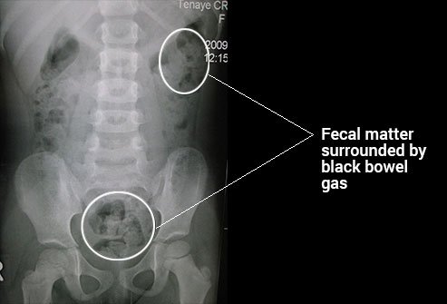 Abdominal X-rays help medical care professionals see the kidneys, ureter, and bladder.