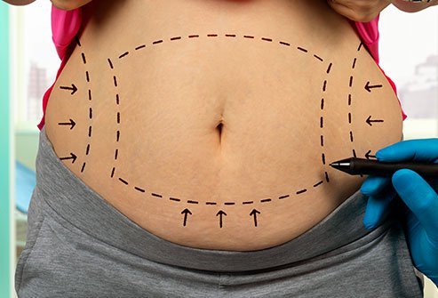 Abdominoplasty (tummy tuck) is a procedure to correct abdominal deformity due to excess skin, subcutaneous tissue and laxity of the abdominal wall musculature.