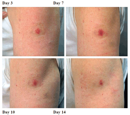 Progression of major cutaneous reaction after revaccination - Illustration