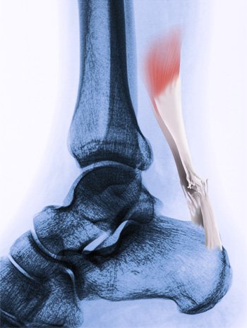 Picture 2 shows the usual site of Achilles tendon rupture.