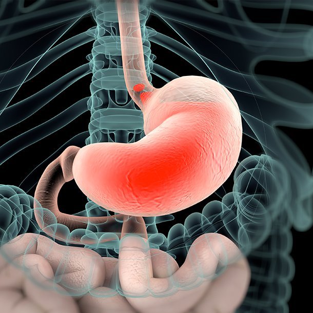 Esophageal pH monitoring is used to measure the reflux (regurgitation or backwash) of acid from the stomach into the esophagus and to diagnose gastroesophageal reflux disease (GERD). Side effects of the procedure are few but may include mild discomfort in the back of the throat while the catheter is placed, and swallowing.