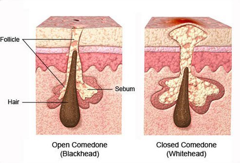 Illustration of Comedones: Blackheads and Whitehead