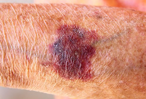 Actinic purpura results from sun-induced damage to the connective tissue of the dermis
