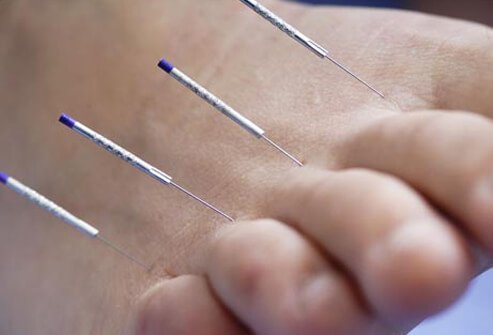 Acupuncture treatment has been attempted across a range of pain types, from menstrual cramps and tennis elbow to neck pain and muscle discomfort.