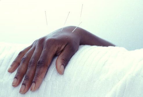 An acupuncturist who can help cancer patients undergoing chemotherapy deal with pain, nausea, and vomiting.