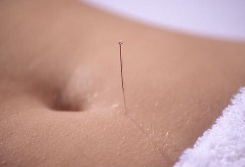 Findings on whether acupuncture helps men and women with fertility have been mixed.