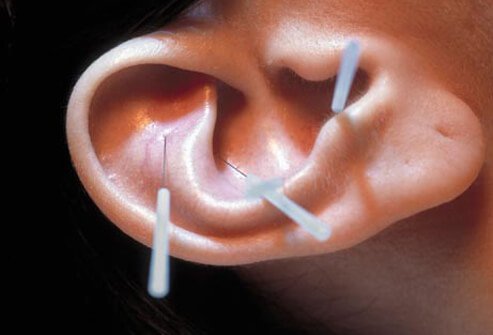 Acupuncture has been used to assist those trying to quit smoking.