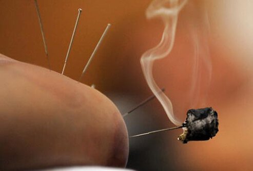 Variations of the practice include moxbustion, electroacupuncture and laser.