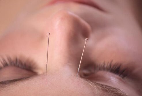 Some research suggests acupuncture may provide effective, temporary relief for chronic tension and migraine headaches.