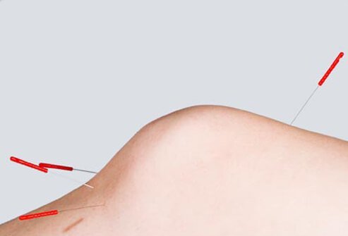 Unfortunately, the effect of acupuncture on RA seems to be limited.