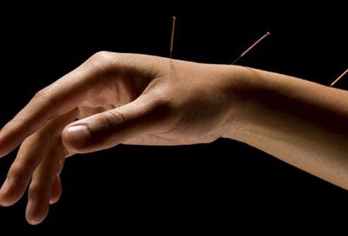 Research on acupuncture for carpal tunnel syndrome shows benefits in some but remains inconclusive.