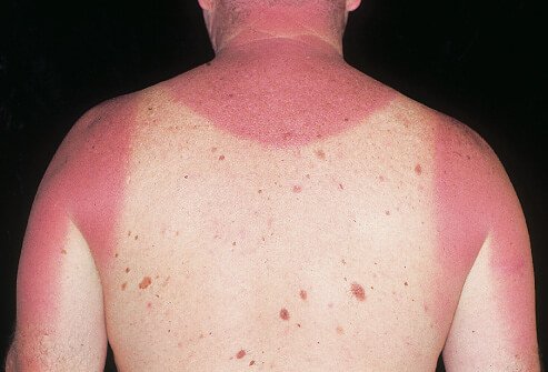 Picture of acute sunburn 