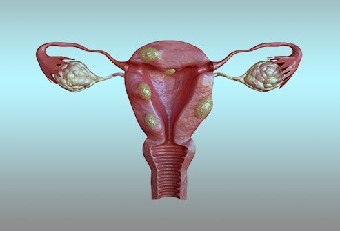 Uterine fibroids are benign (noncancerous) growths in the uterus