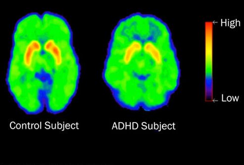 ADHD Causes
