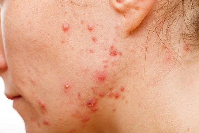 PCOS may be associated with adult acne in women.
