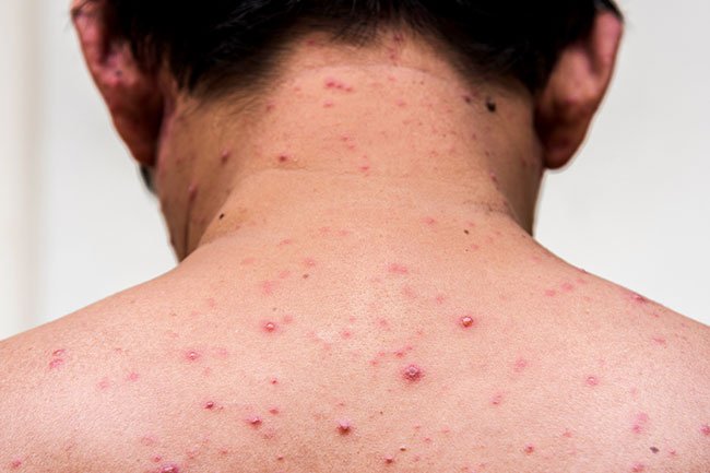 The face is not the only place where acne can develop. Some people get it on their back.