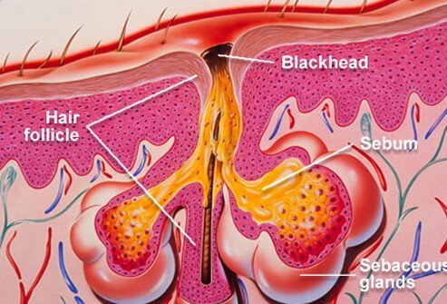 Blackheads are one type of acne lesion.