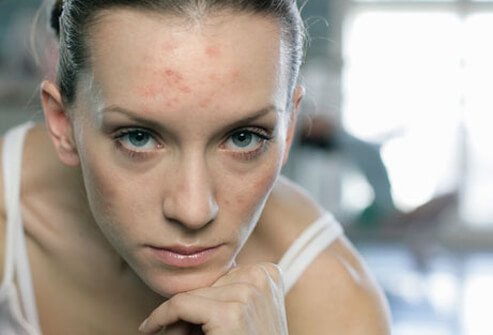Acne is not related to anemia, but low folate may play a role.