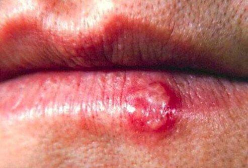 Picture of Cold Sores (Fever Blisters)