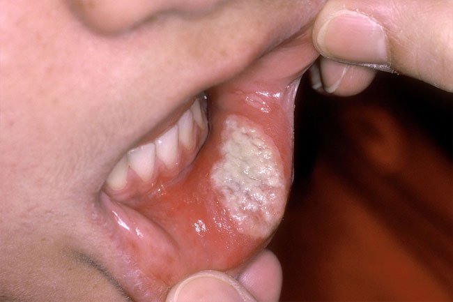 Major canker sores are bigger than minor canker sores and they are very painful and take longer to heal.