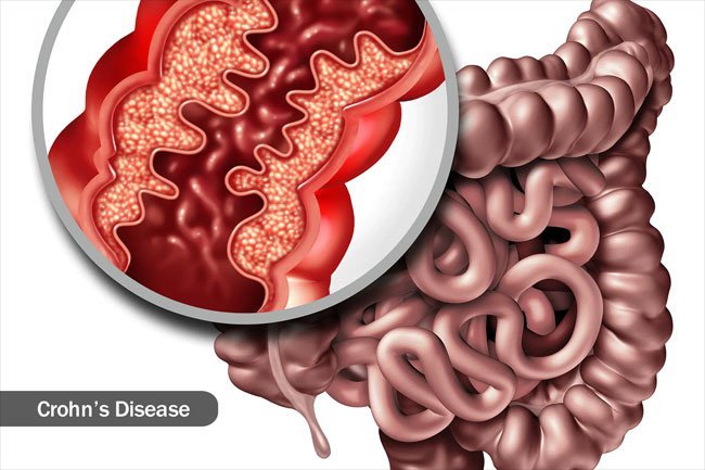 Autoimmune and inflammatory disease are just a few conditions that cause canker sores.
